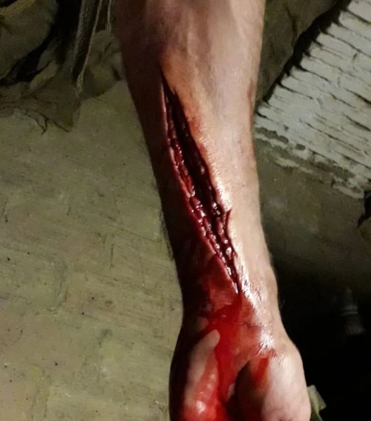 herida brazo herida brazo